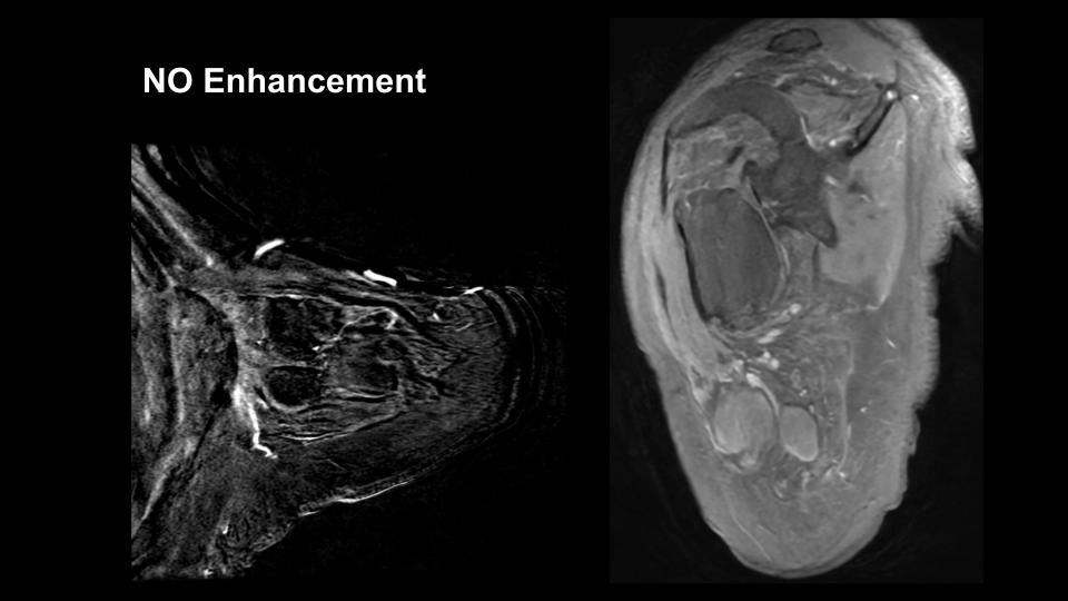 Figure 3 for case Stump neuromas